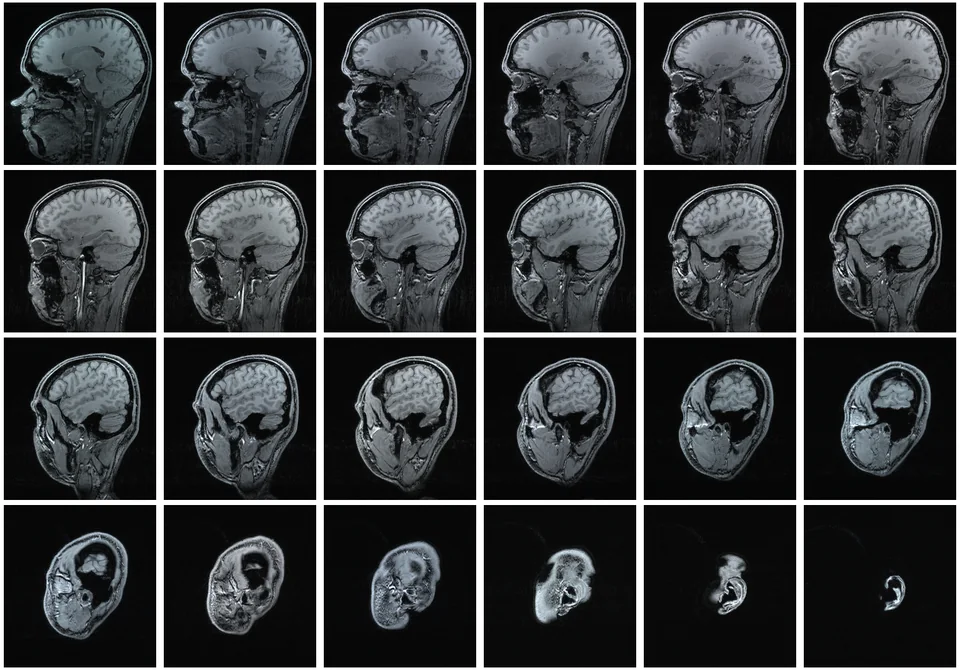 A grid of MRI slices showing progressively different sections through a human head and brain.